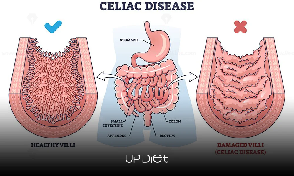 what causes celiac disease